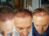 Fue Hair Transplant at sl Clinic