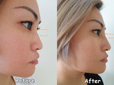 Non-surgical Nose Job with sl Clinic