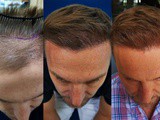 Update on fue Hair Transplant