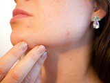 12 Foods to keep off Pimples and Acne at bay
