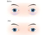 How to get rid of dark circles