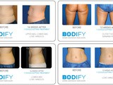 Utilizing CoolSculpting and Other Strategies for Weight Loss