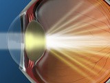 Common symptoms of cataracts