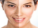 2 Best Remedies for Winkle Remover on Face